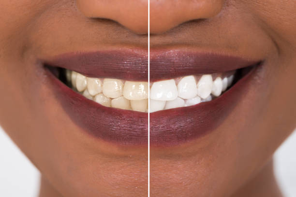 Dentilab V34 – Le Secret d’un Sourire Éclatant, Naturel et Instantané.